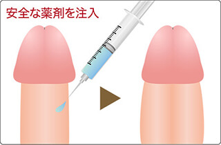 ペニス増大：陰茎増大術