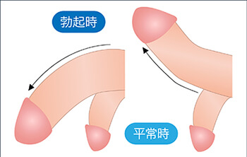 上下方向に曲がる症状