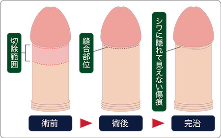 亀頭直下埋没法