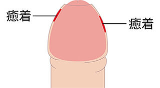 真性包茎_癒着型