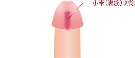 早漏治療：小帯切除法