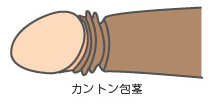 カントン包茎