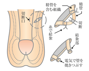 パイプカット（男性避妊手術）大阪院