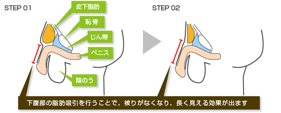 下腹部脂肪吸引長茎術