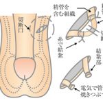 パイプカットについてのお話